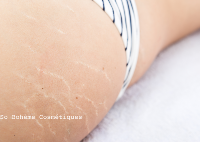 Prendre soin des vergetures au naturel